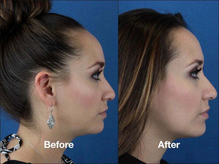 Before and after side profile comparison of woman.