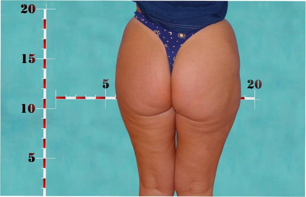 Blog image for Introducing VASER Shape: The Newest Non Surgical Device For Ridding Unwanted Fat