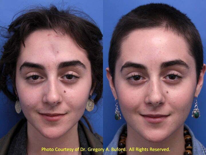 Blog image for How to Erase Facial Scars:  A Patient Example