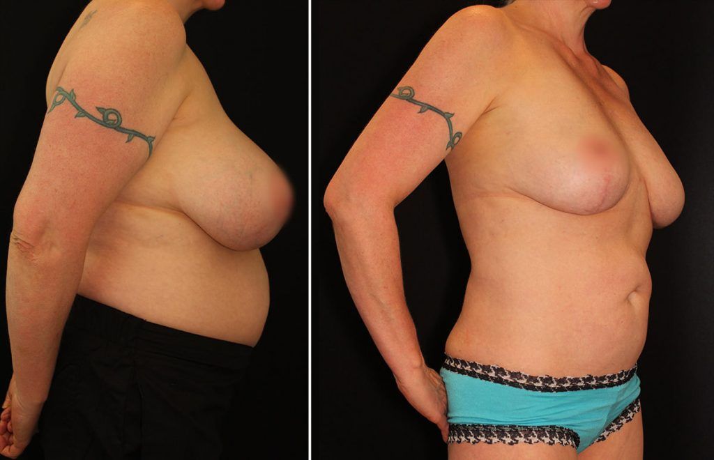 Blog image for Can I Make My Breasts Bigger Without Implants? What You Need to Know About Natural Breast Augmentation