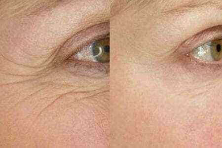 Blog image for How can I improve the results of my BOTOX treatment?