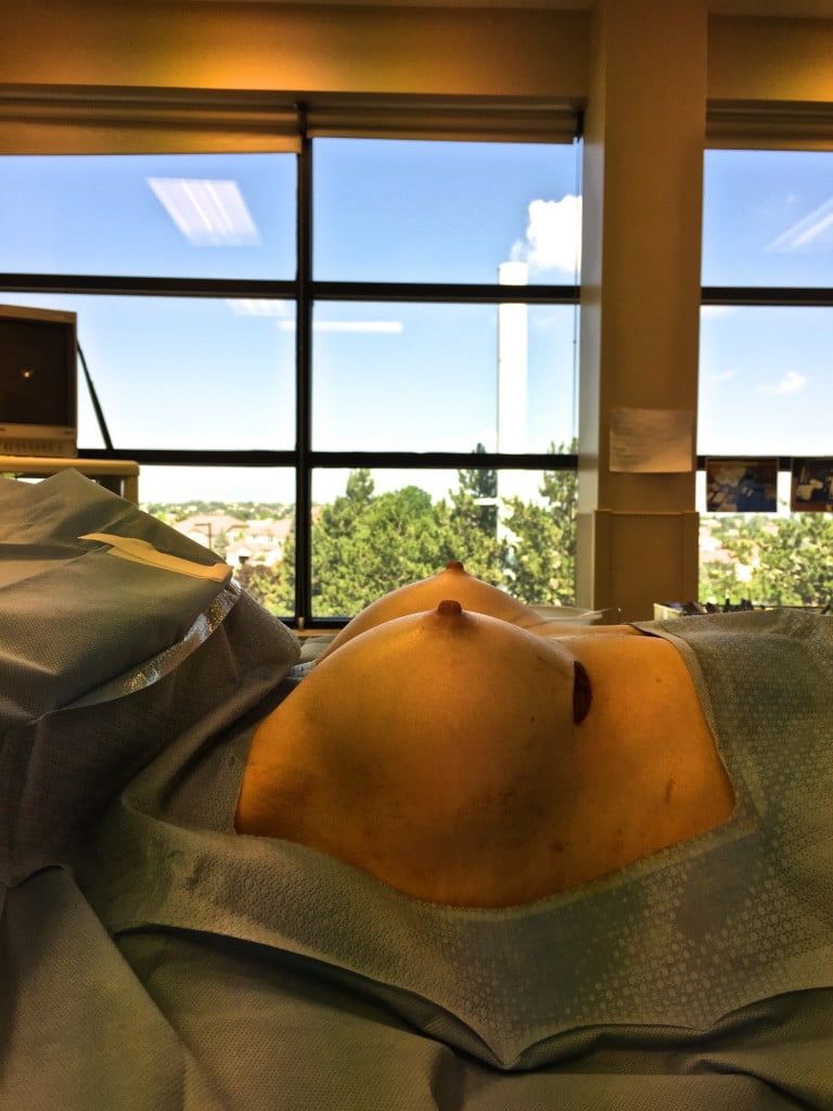 Blog image for Looking for more Upper Pole Fullness?  Check out the new INSPIRA Breast Implant!