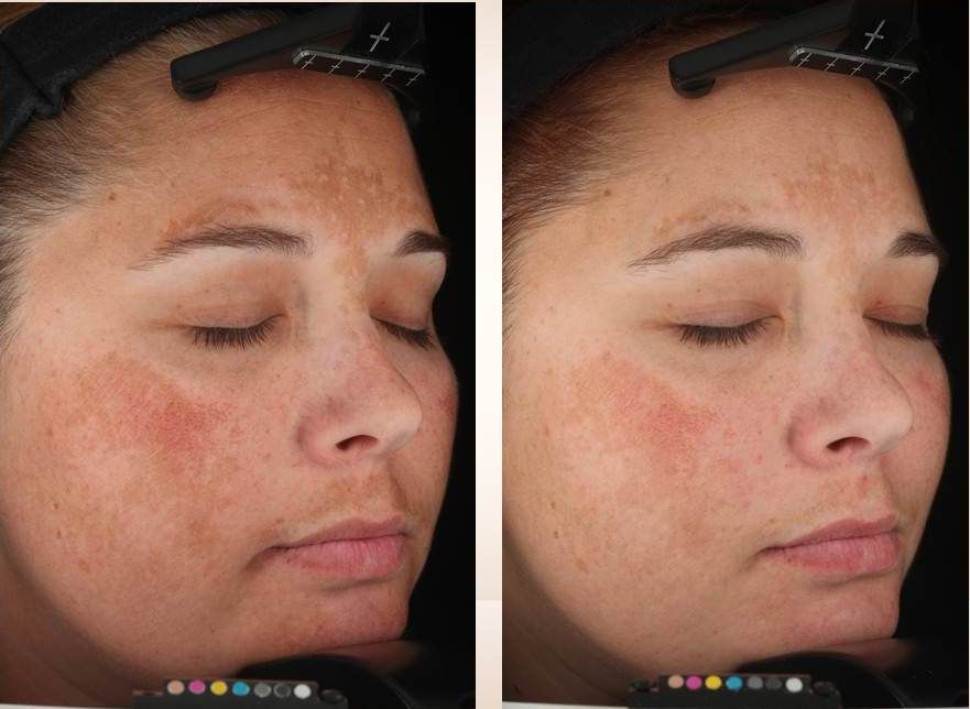 Blog image for Get rid of Brown Spots for Good!  Now 20% off for June & July!
