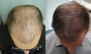 Blog image for How Can I Regrow Hair Without Surgery?