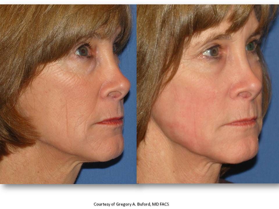 Blog image for Interested in a laser procedure but concerned about the expense?  I may have an answer.