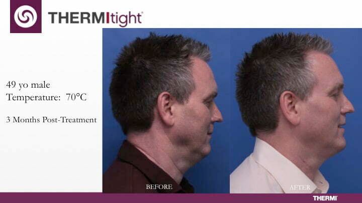 Blog image for How can I improve the appearance of my neck?