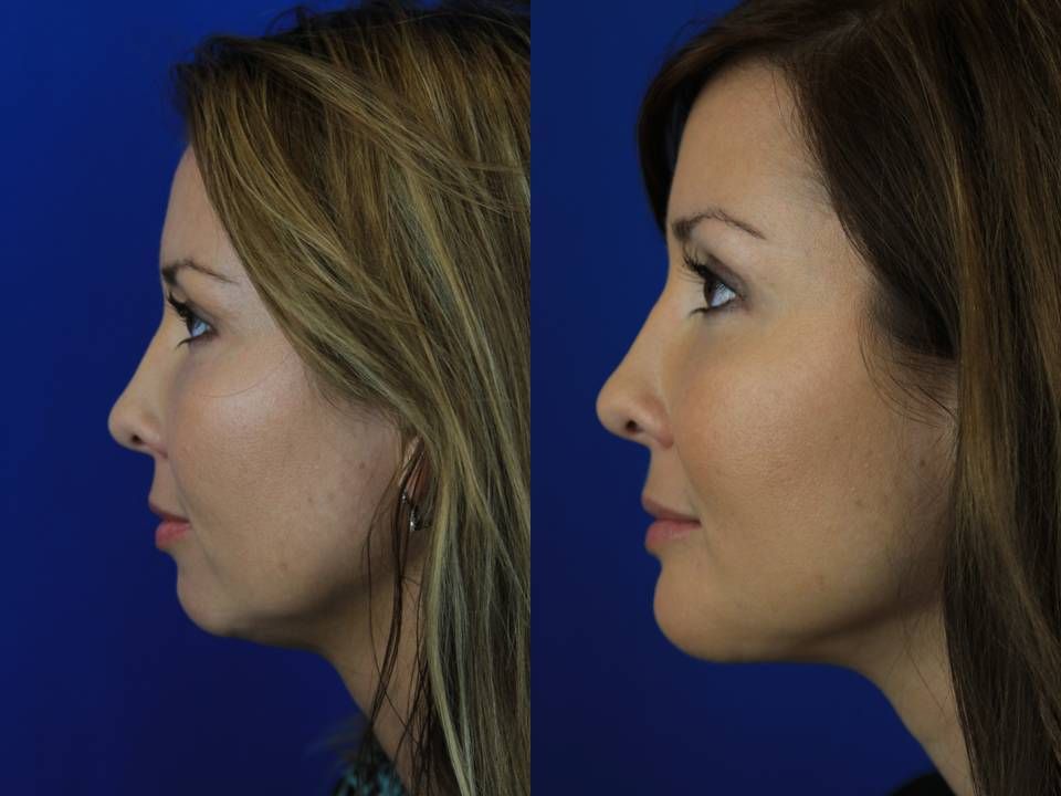 Blog image for Dry Eyes?  Be Careful with An Eyelid Procedure.