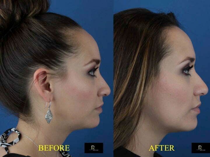 Blog image for Does Kybella Really Work?