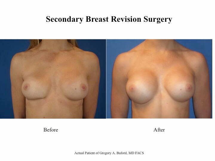 Blog image for Breast Augmentation Revision:  A Patient Example