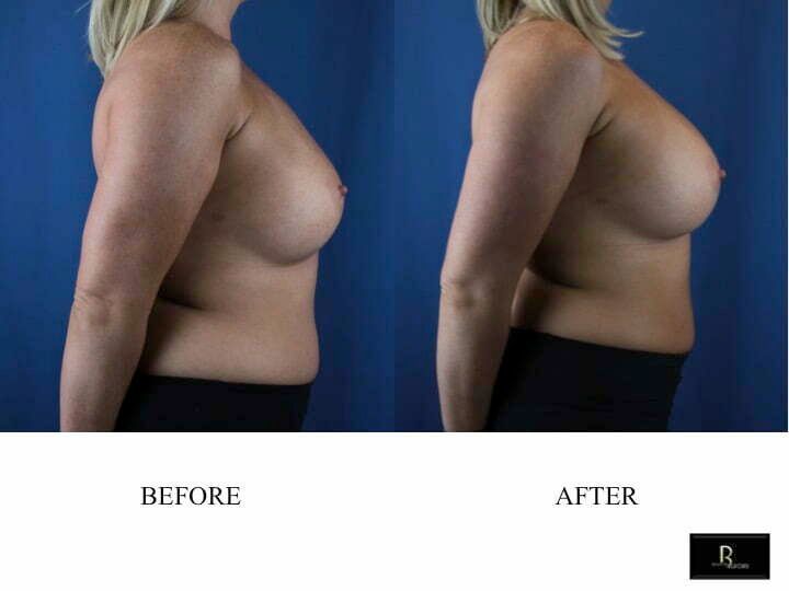Blog image for How can I increase upper pole projection of my breasts?