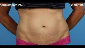 Blog image for How do I Tighten Loose Skin Without Surgery?