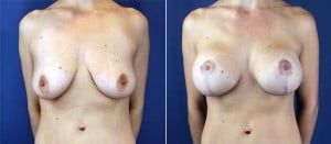 breast-lift-with-implants-3172a