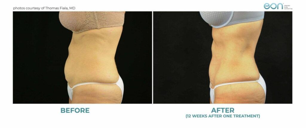 How Can Body Contouring Improve Your Overall Appearance?