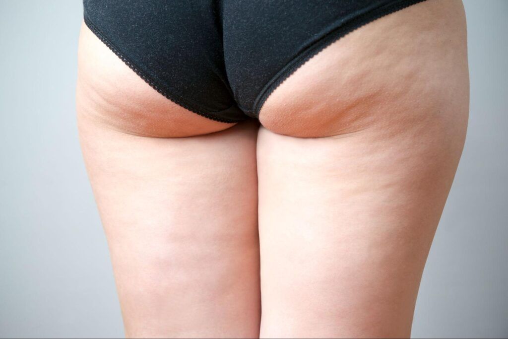 Blog image for Why Choose Avéli™ for Cellulite Treatment?