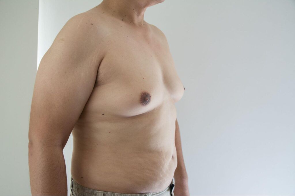 Am I A Good Candidate for Male Breast Reduction Surgery?