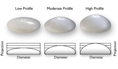 Blog image for Considering Breast Implant Removal?