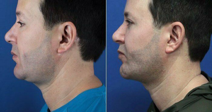 Kybella (neck/jawline)