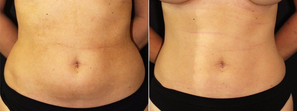 Liposuction - Before and After