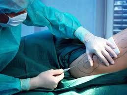 Blog image for Is Liposuction Really Safe?