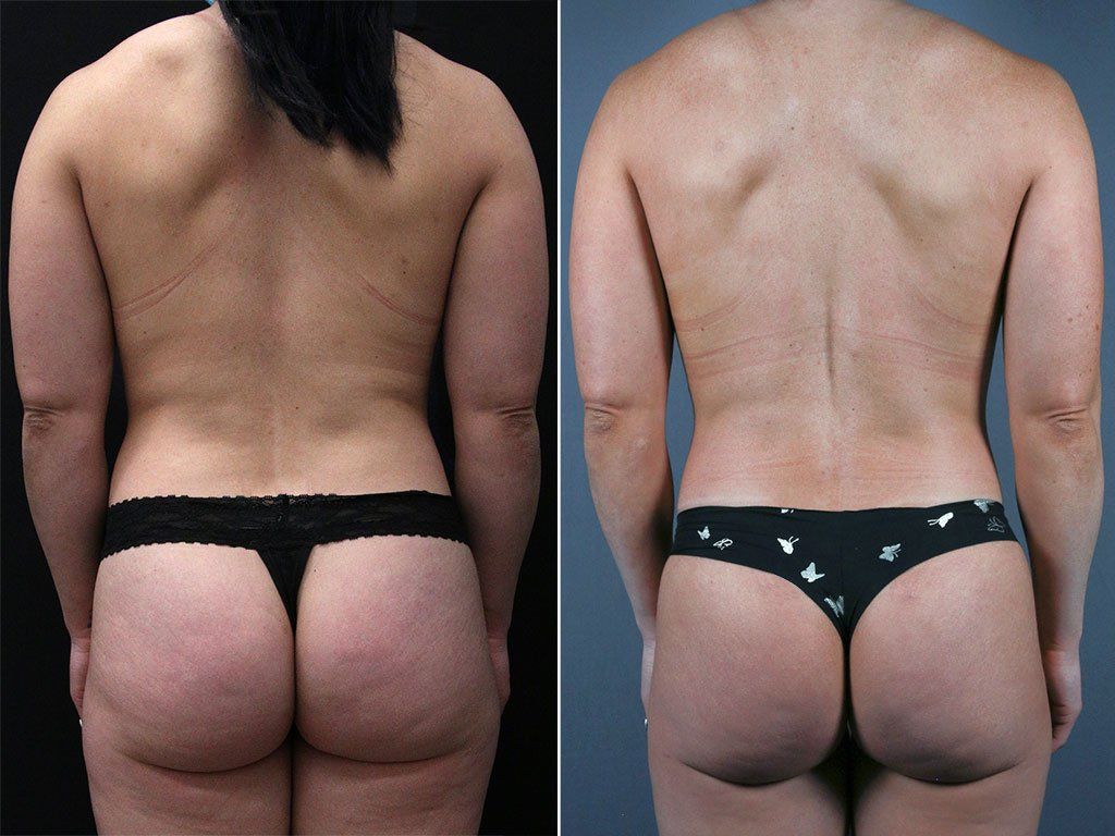 Real Patient of Gregory A. Buford, MD, FACS, PCEO following treatment with Renuvion