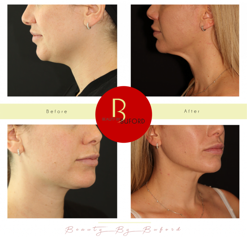 Blog image for ICYMI, the Future of Skin Tightening is Here: Helium Plasma + RF