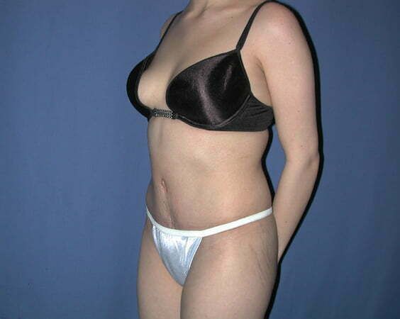Blog image for Is Liposuction Really Necessary with a Tummy Tuck?