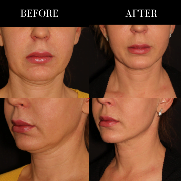 Renuvion results before and after