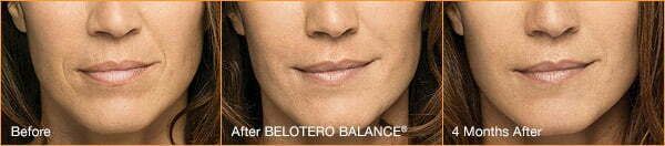Before and after Belotero Balance treatment comparison.