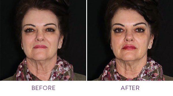 Before and after cosmetic treatment comparison.