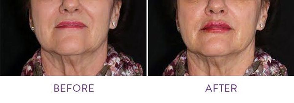 Before and after cosmetic treatment comparison.