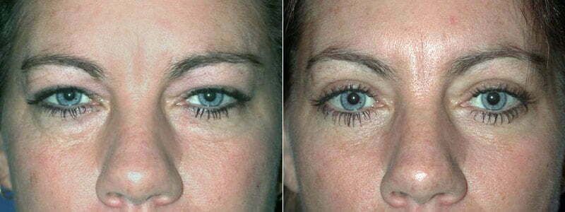 Before and after eye treatment comparison.