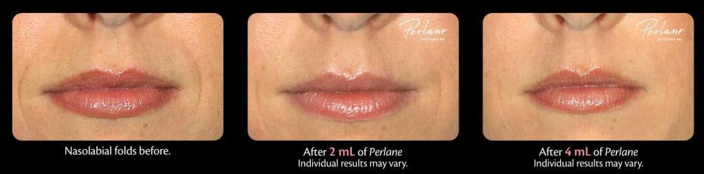 Nasolabial folds treatment before and after photos.