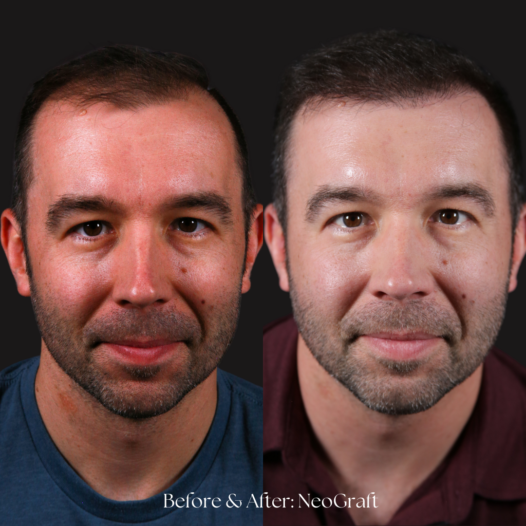 Hair Restoration | NeoGraft Before & After