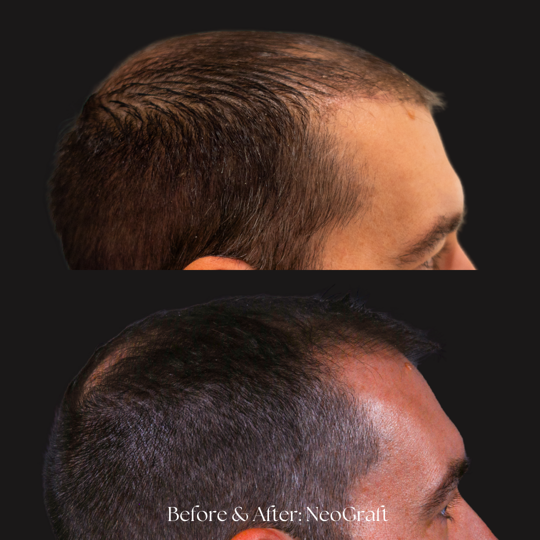 Hair Restoration | NeoGraft Before & After