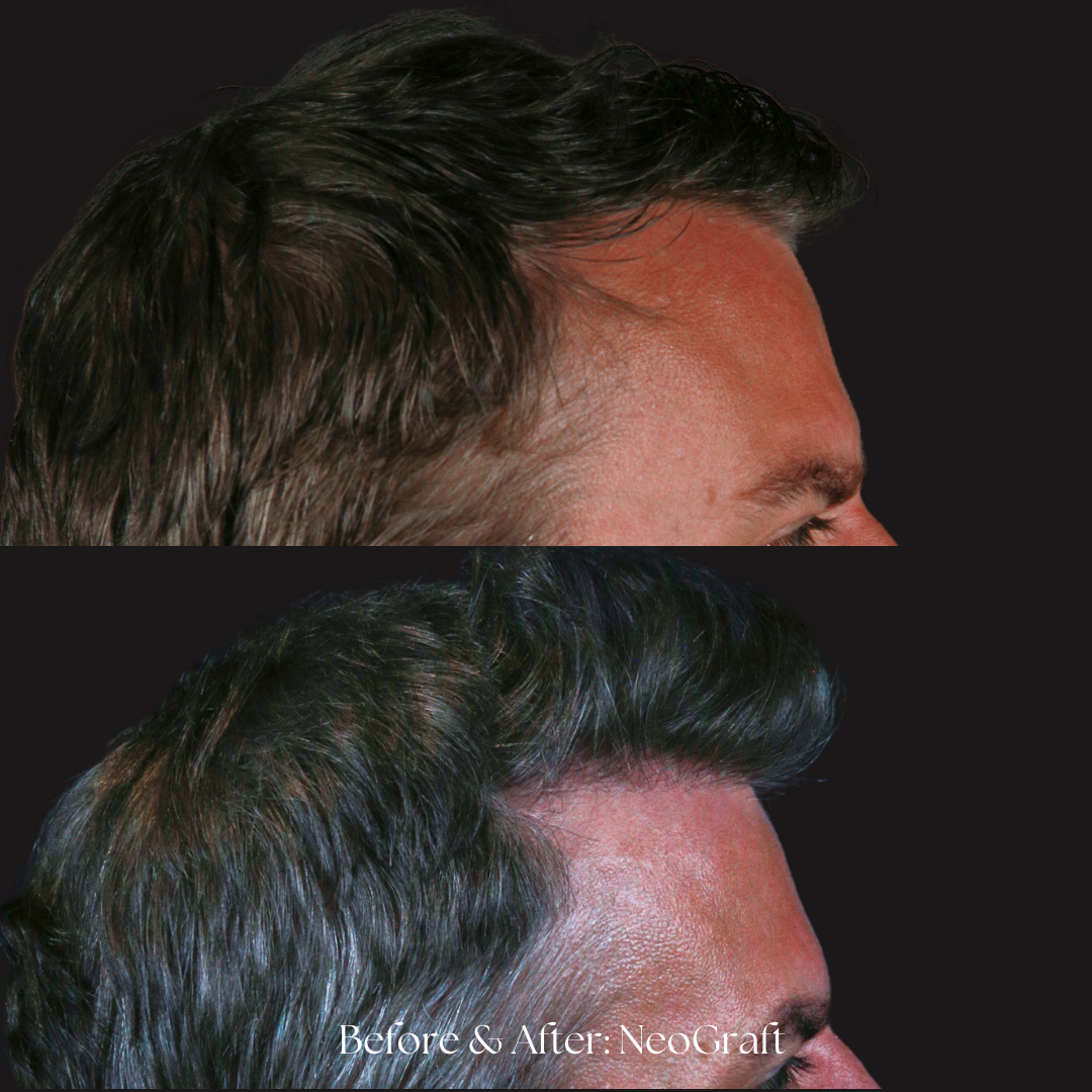 Hair Restoration | NeoGraft Before & After