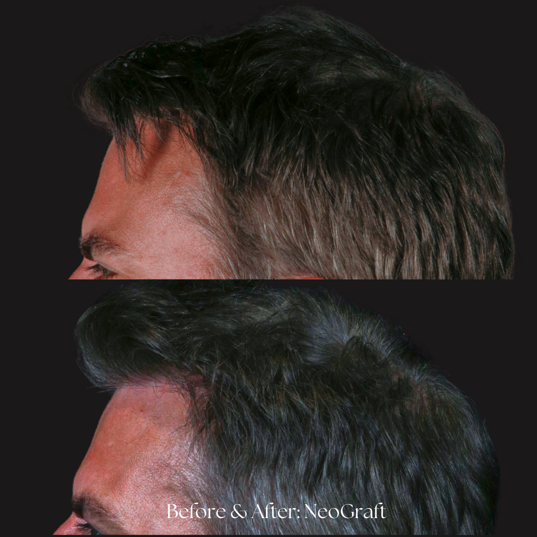 Hair Restoration | NeoGraft Before & After