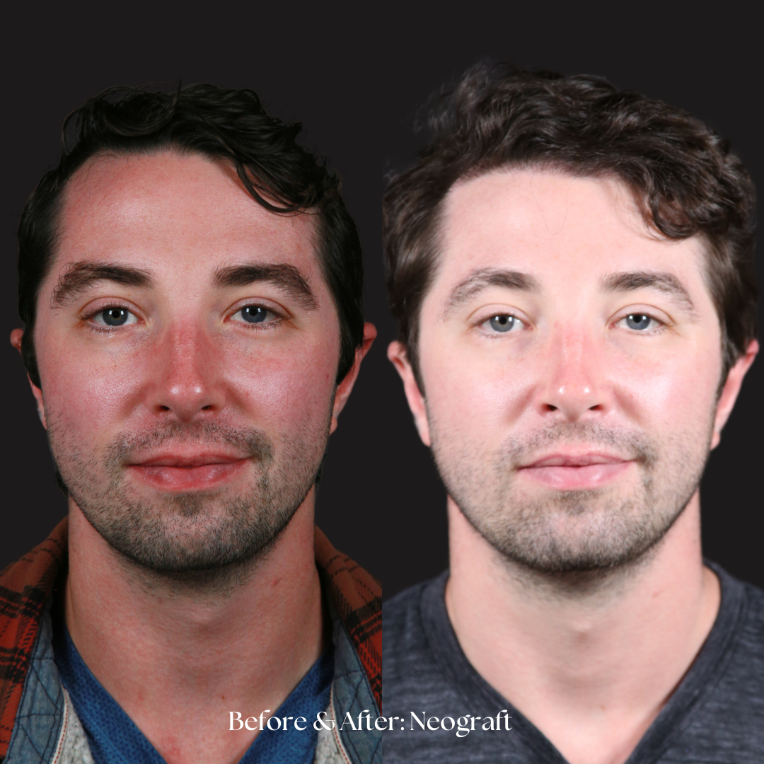 Hair Restoration | NeoGraft Before & After