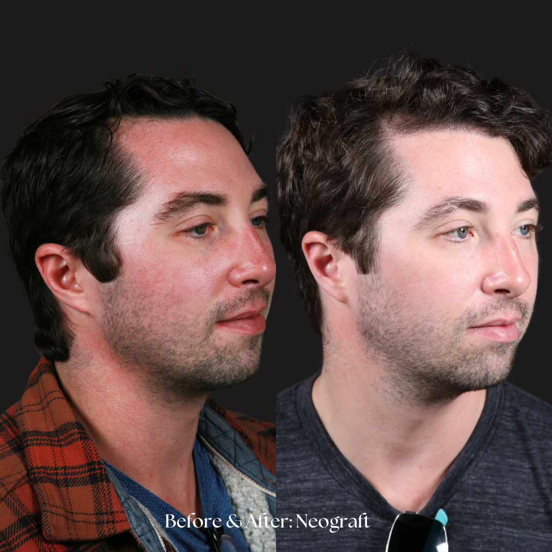 Hair Restoration | NeoGraft Before & After