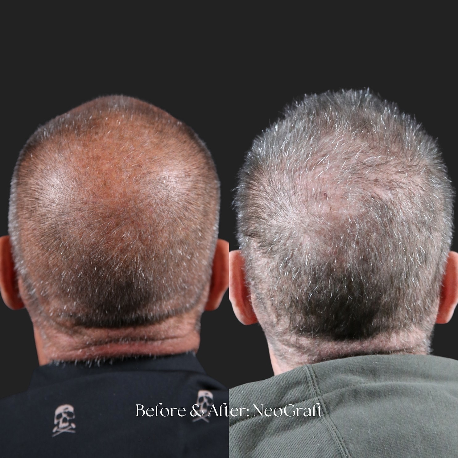 Hair Restoration | NeoGraft Before & After