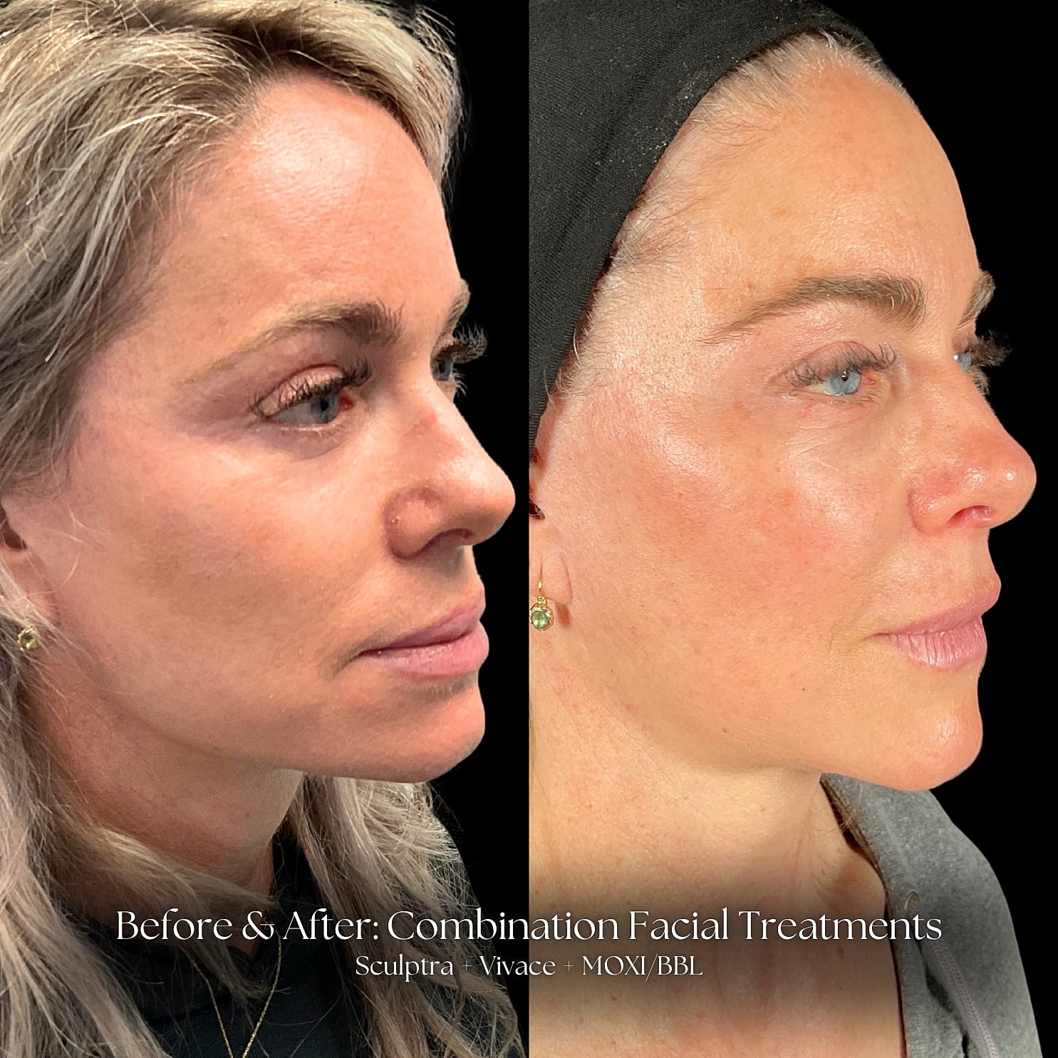 Combination Facial Treatment Before & After