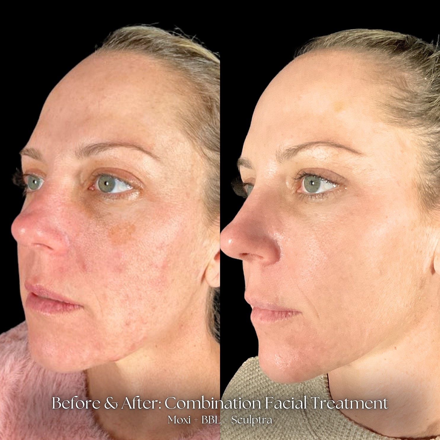 Combination Facial Treatment Before & After
