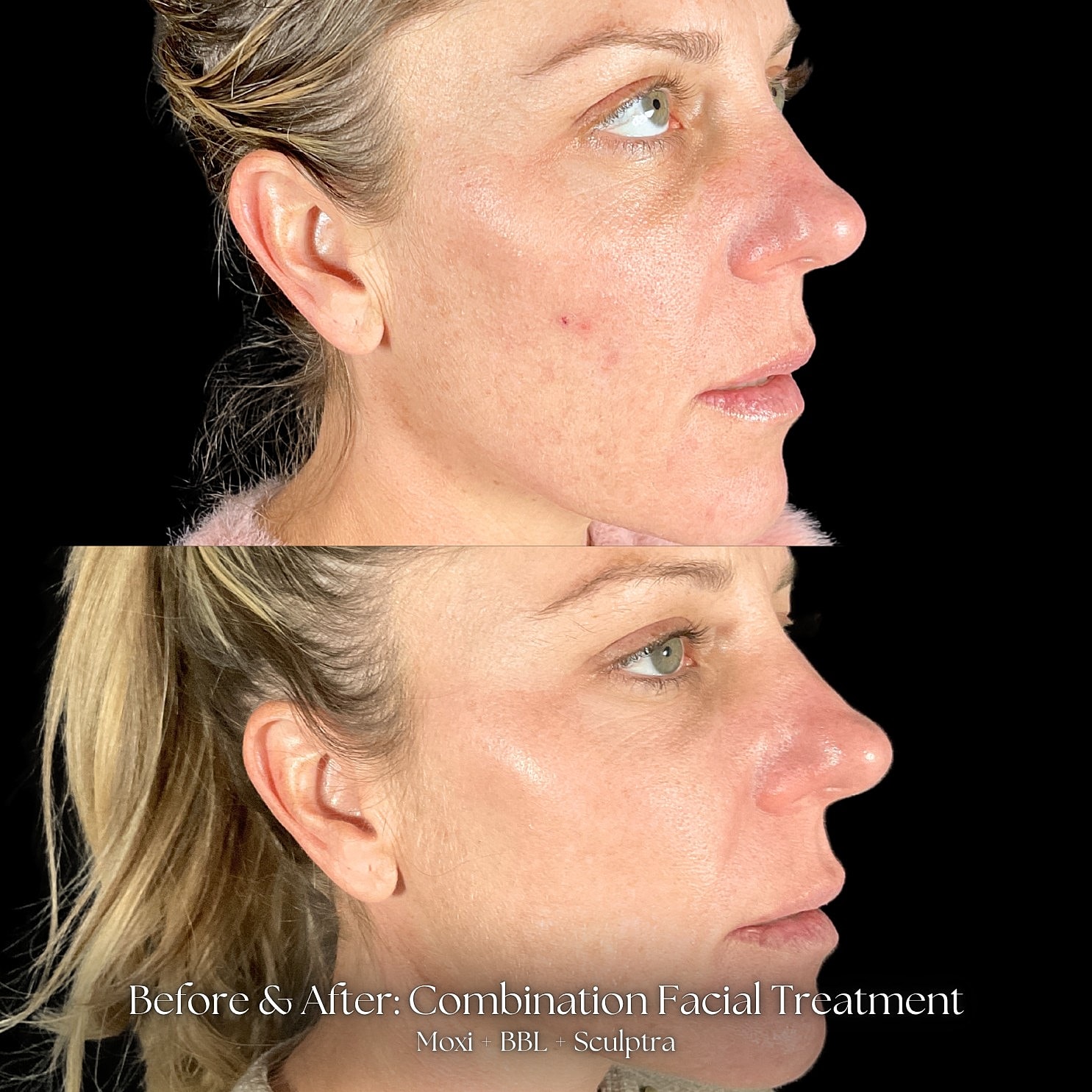 Combination Facial Treatment Before & After