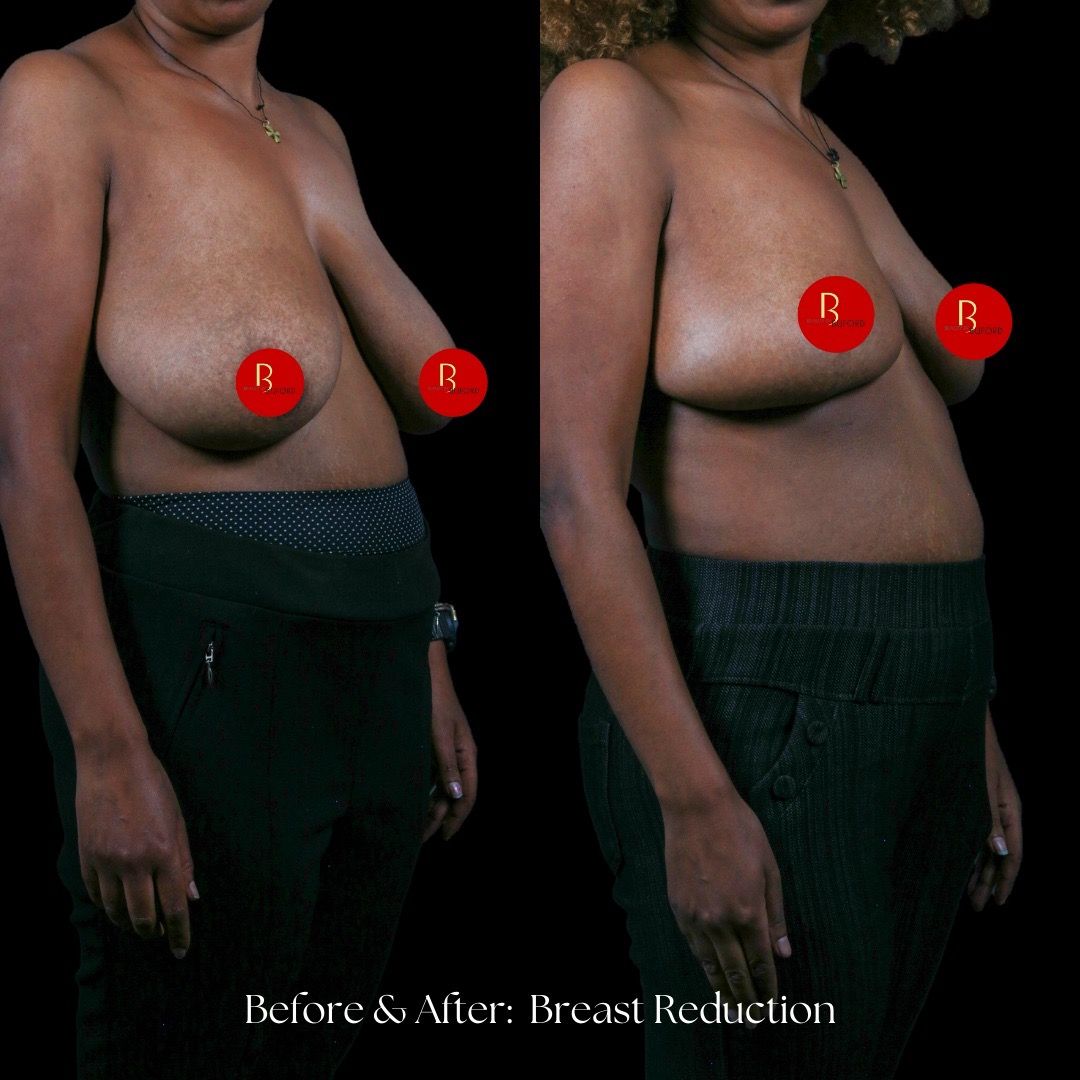 Breast Reduction Before & After