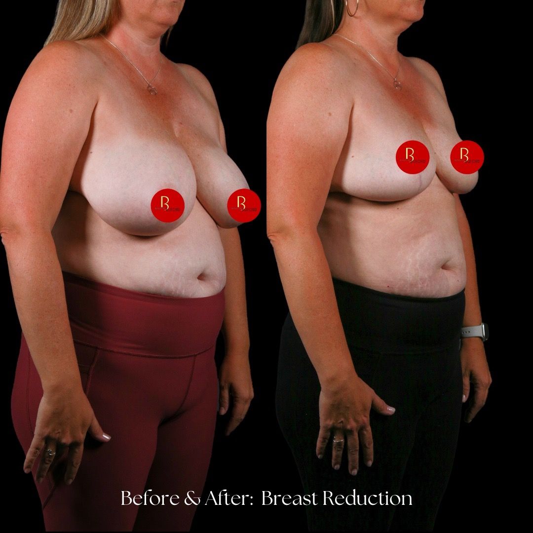 Breast Reduction Before & After