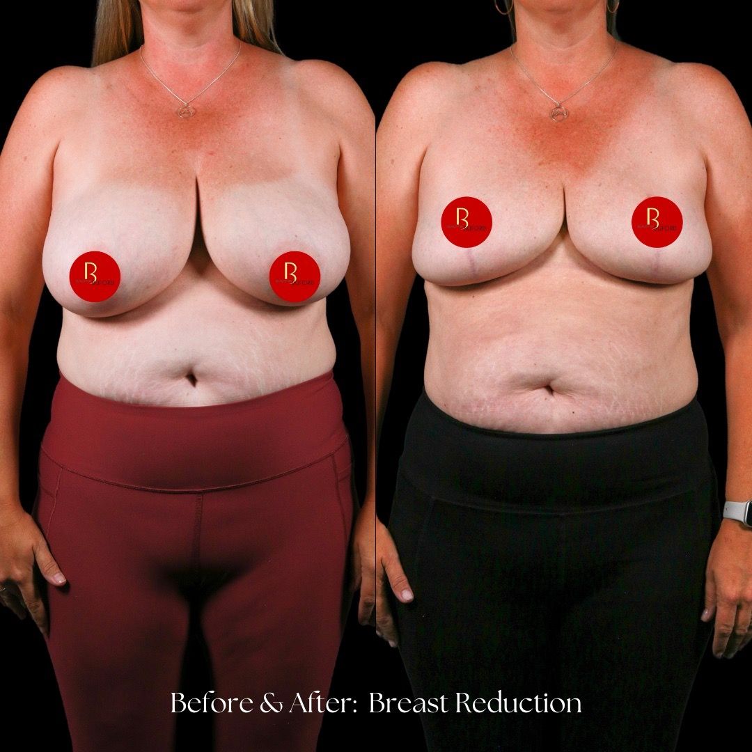 Breast Reduction Before & After