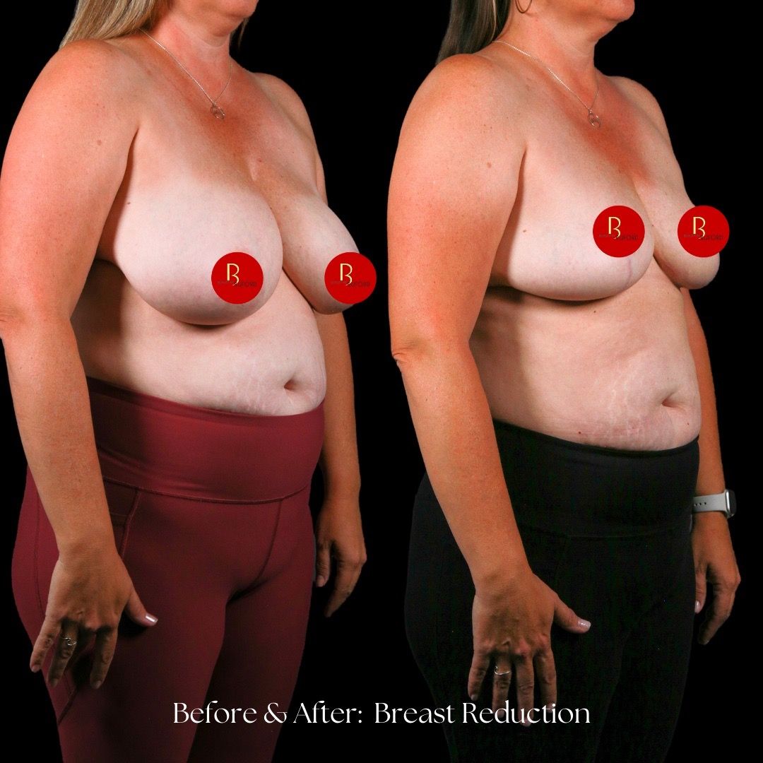 Breast Reduction Before & After