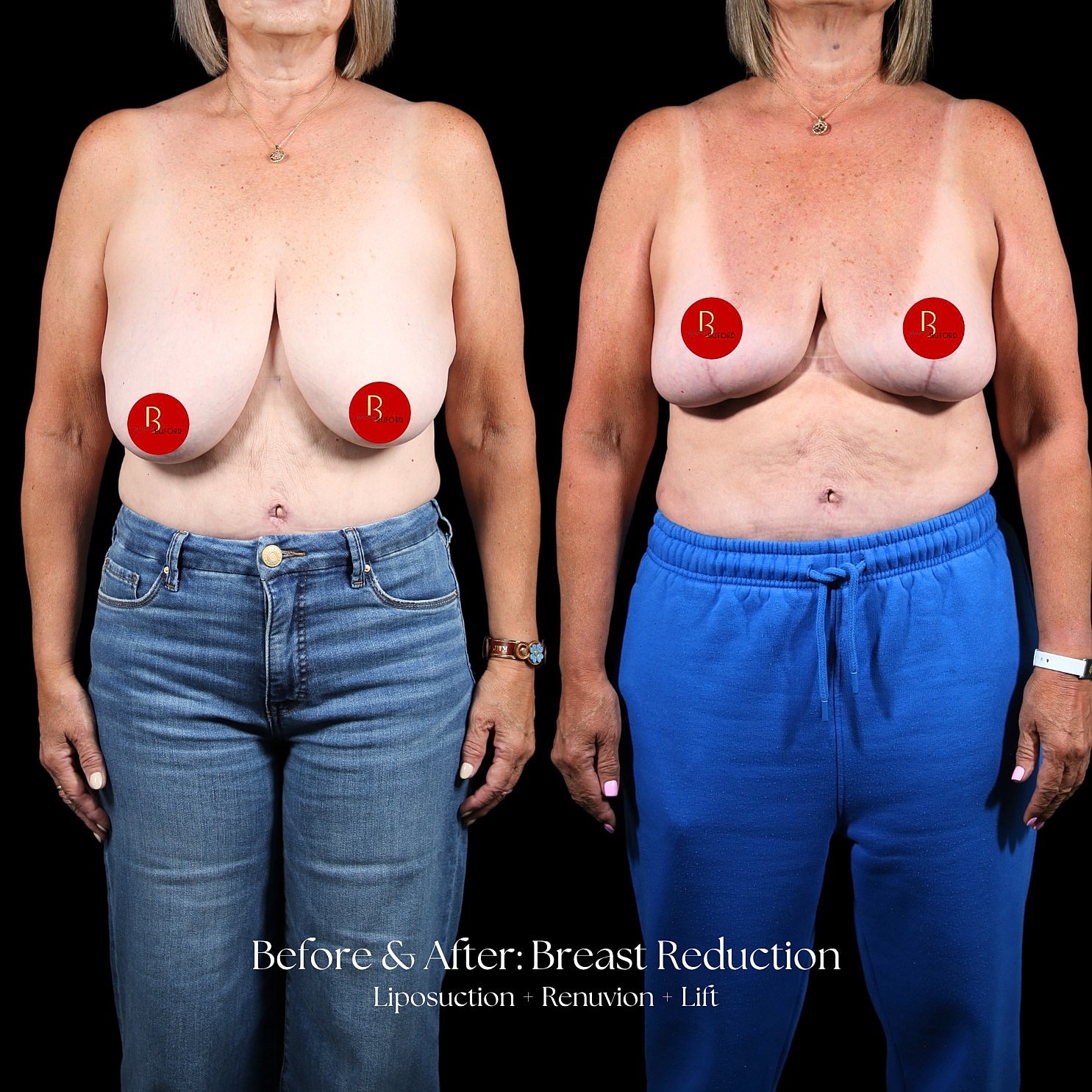 Breast Reduction Before & After