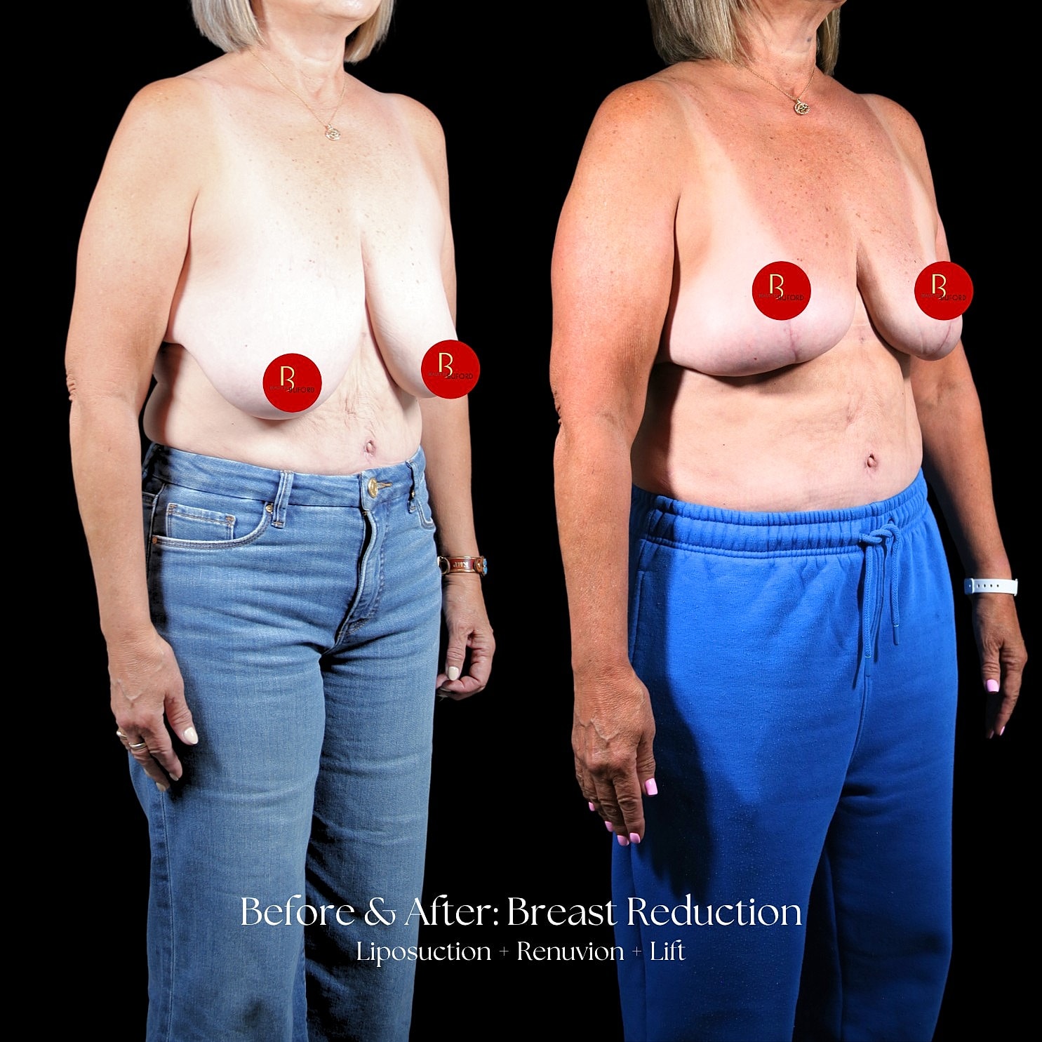 Breast Reduction Before & After