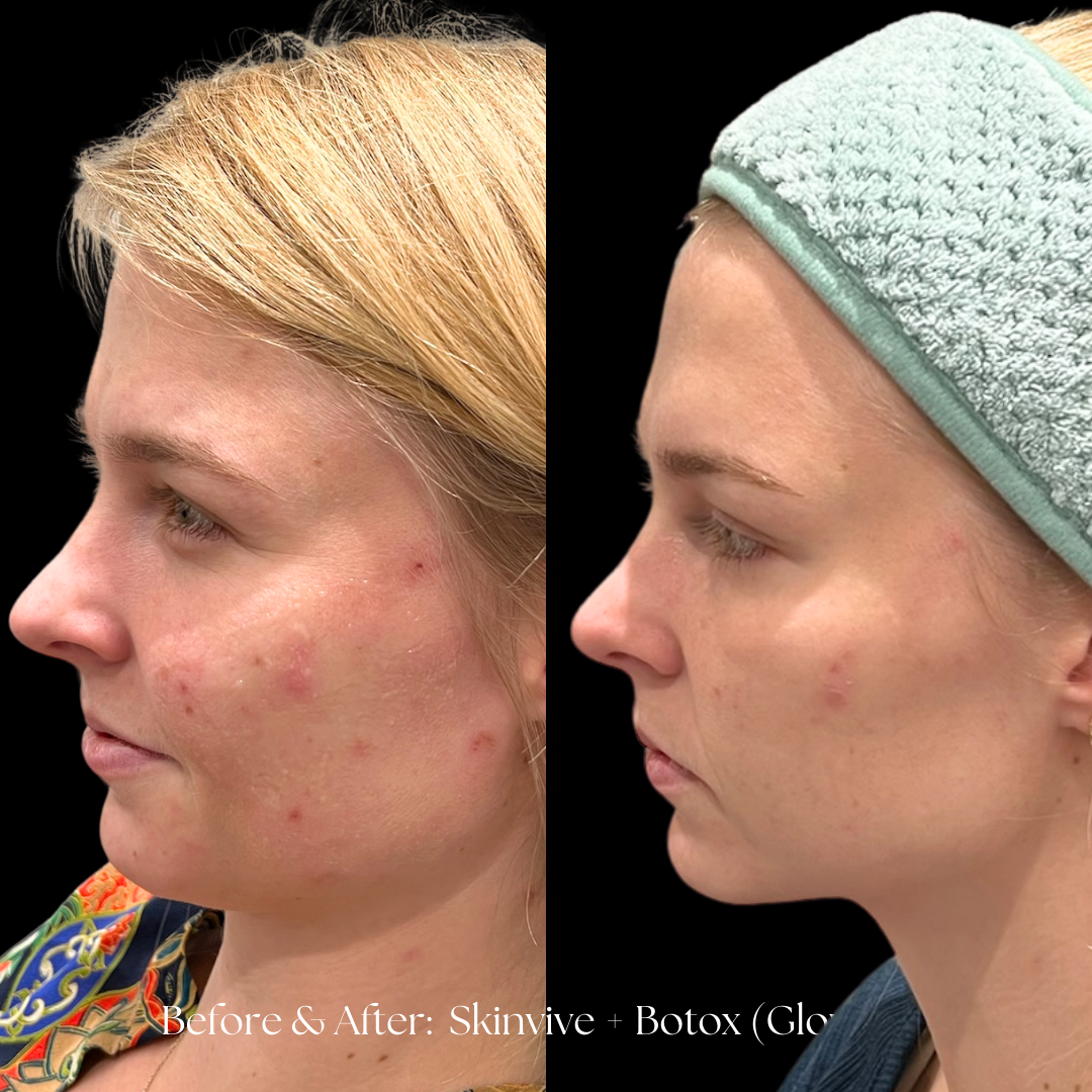 SKINVIVE Before & After