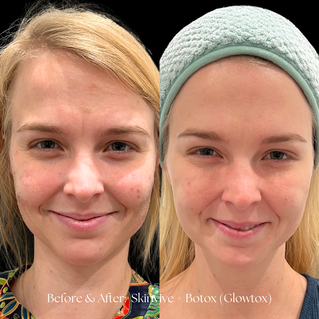 SKINVIVE Before & After